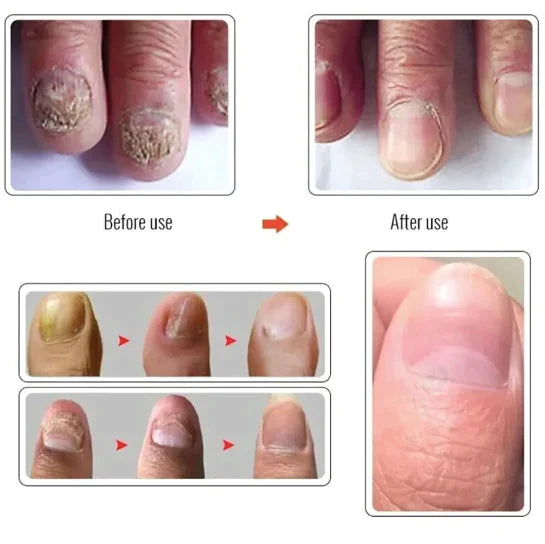 Nail Serum for Nail Growth & Repair, Fungal Infection, Anti-infective Removal