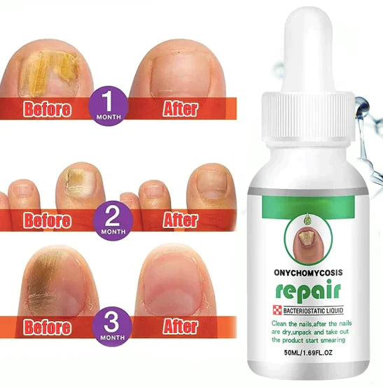 Nail Serum for Nail Growth & Repair, Fungal Infection, Anti-infective Removal